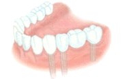 You may refuse from removable teeth prosthesis even if you have completely all teeth missed.